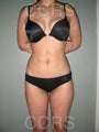 VASER lipo - 28 yrs. old (abdomen, back, flanks & thighs)