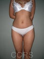 VASER lipo - 28 yrs. old (abdomen, back, flanks & thighs)