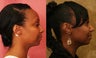 African American Rhinoplasty