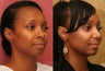 African American Rhinoplasty