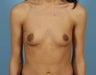 26 year old lady for breast enhancement