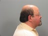 Neck Lift