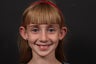 10 year old female, otoplasty