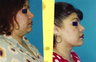 6 Month Post Operative Neck Lift