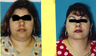 6 Month Post Operative Neck Lift