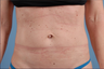 truSculpt
