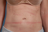 truSculpt