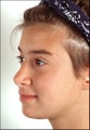 Rhinoplasty