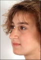 Rhinoplasty