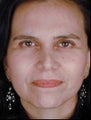 Female Revision Rhinoplasty