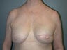 Female patient who underwent breast reconstruction
