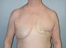 Female patient who underwent breast reconstruction
