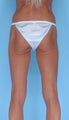 49 Year Old Female Treated with Lateral Thigh Lift