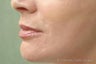 Juvederm®