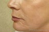Juvederm®