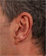 58 year old male with left prominent ear causing emberrassment and distress