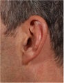 58 year old male with left prominent ear causing emberrassment and distress