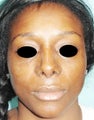 36 year old female treated with open rhinoplasty