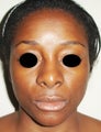 36 year old female treated with open rhinoplasty