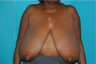 6 Month Post Operative Breast Reduction