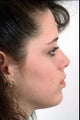 Rhinoplasty