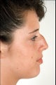 Rhinoplasty
