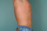 Smart Lipo