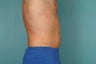 Smart Lipo