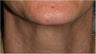 55 Year old female with aging neck due to neck bands. She doesn't want a surgical neck lift