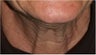 55 Year old female with aging neck due to neck bands. She doesn't want a surgical neck lift