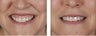 Female Treated For Gummy Smile With Botox