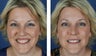 Female Treated For Gummy Smile With Botox