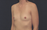 Breast Augmentation