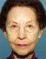 Skin Resurfacing - Before & After
