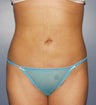 Vaser Liposelect