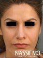 Female Primary Rhinoplasty