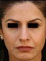 Female Primary Rhinoplasty