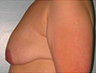 Breast Lift