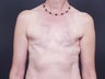 51 Year Old Feamale for Breast Reconstruction
