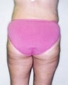 Female patient who underwent a butt lift