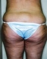 Female patient who underwent a butt lift