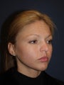 Chin Implant Patient
