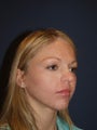 Chin Implant Patient