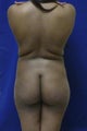 Brazilian Butt Lift via fat transfer