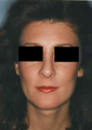 Revision Rhinoplasty