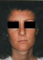 Revision Rhinoplasty
