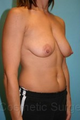 Breast Lift