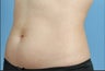 truSculpt