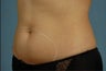 truSculpt