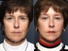 Brow Lift